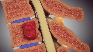 Spine Injury Animation with Hemangioma [upl. by Lee369]