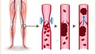 Lecture193 Varicose Veins DVT Superficial thrombophlebitis amp Venous Insufficiency Rook Ch 103 [upl. by Esilahc]