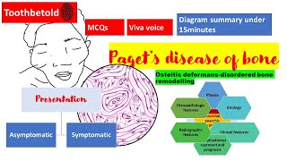 Pagets disease of bone  RadiographHISTOPATHOLOGYclinical features  NBDENEET MDSBDS  Diagrams [upl. by Harned]