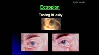 A Class On Ectropion By Dr VivekanandDept Of Ophthalmology [upl. by Canty872]