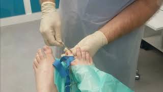 Podiatry nail surgery in 12 minutes to permanently cure ingrown  ingrowing toenails [upl. by Ocirema482]