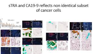 sTRA amp CA199 glycans express nonidentical subset of pancreatic cancer cell populations Code 695 [upl. by Mairb]