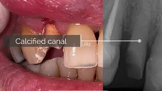 UR2 Calcified RCT Quick clinical case [upl. by Kaenel]