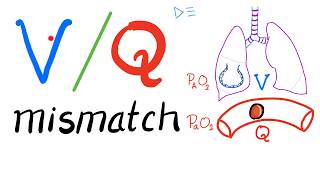 Ventilation Perfusion Ratio VQ and VQ Mismatch  Respiratory Physiology amp Pulmonology [upl. by Yenahc]