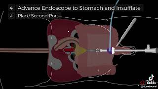 LaparoscopicAssisted Percutaneous Endoscopic Gastrostomy PEG Tube Placement Steps [upl. by Denice24]