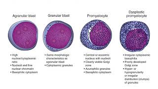 Myelodysplastic Syndrome [upl. by Lyall682]