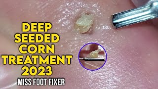 2023  Podiatrist Removes Painful Deep Seeded Corn From Sole Of Feet  MISS FOOT FIXER [upl. by Gati592]