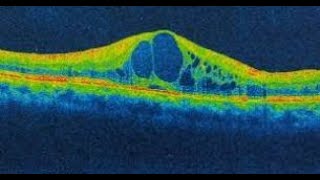 Cystoid Macular Edema [upl. by Wiles]