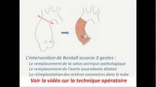 Lintervention de Bentall en 1 minute [upl. by Latty]