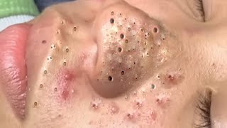 Big Cystic Acne Blackheads Extraction Blackheads amp Milia Whiteheads Removal Pimple Popping  3628 [upl. by Ralip165]