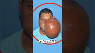 His footballsized tumor was removed😲 [upl. by Irotal]