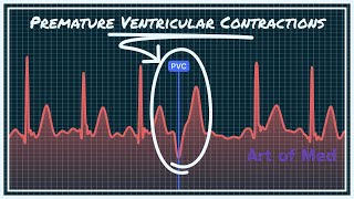 Premature Ventricular Contrcations Ventricular Bigeminy Trigeminy Quadrigeminy [upl. by Aneeg]