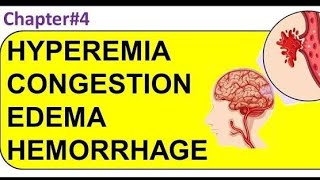 Pathology Hyperemia Congestion and Edema افضل شرح باثولوجي بالعربي الاحتقان والتورم د فادي مجدي [upl. by Inglis]