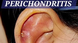 perichondritis earpain swelling treatment drbaisalisarkar ENTSurgeon kolkata [upl. by Loella90]