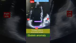 Ebstein Anomaly Echo l Birth defect l echo heart shorts [upl. by Omle]