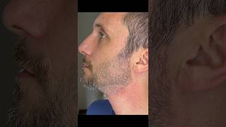 Stubble Beard 2mm VS 1mm [upl. by Naujet]