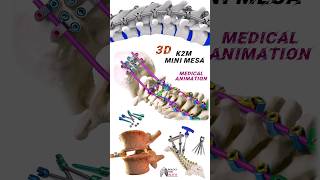 K2M Mini Mesa medical animation 3d short Biology with Aliya [upl. by Lory]