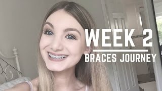 Progress Update amp Advice On Getting Food Out Of Your Braces  WEEK 2 [upl. by Silvie]