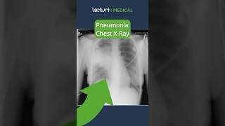 Understanding Lobar Pneumonia 🫁 MedicalEducation usmle [upl. by Nikolai]