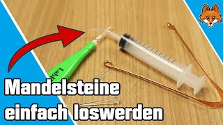 Mandelsteine selbst entfernen und ausdrücken  Mandelsteine loswerden 😷 [upl. by Hertzfeld]