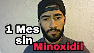 Que pasa si DEJAS el Minoxidil en un 1 Mes [upl. by Bough]