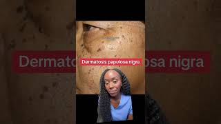 Why Do I Have These Dark Skin Spots Understanding Dermatosis Papulosa Nigra [upl. by Esinaej]