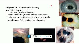 iridocorneal endothelial syndrome [upl. by Avelin193]