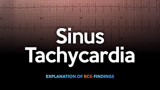 Sinus Tachycardia ECG [upl. by Goth439]