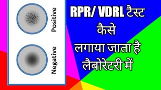 RPRVDRL Test for SyphilisRPR sreening  RPR Antigen test in hindi [upl. by Lanevuj]