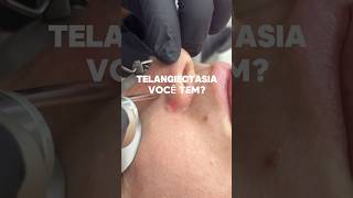 Telangiectasia você tem [upl. by Letney]