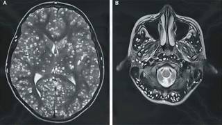 CISTICERCOSIS CAUSAS SÍNTOMAS Y TRATAMIENTO  EPILEPSIA POR CISTICERCOSIS  CISTICERCO CÓMO PREVENIR [upl. by Ezzo]