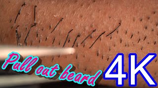 Beard removal tweezers super high quality zoom ASMR [upl. by Farrell391]