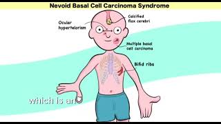 Gorlin syndrome nevoid basal cell carcinoma syndrome  Mnemonic  easy learning [upl. by Zetra]