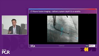 Transformative imaging in the clinical pathway of transcatheter tricuspid valve interventions [upl. by Rhodes713]