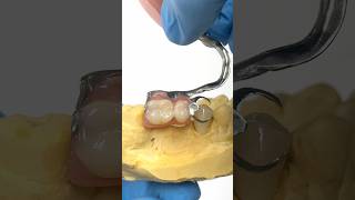 Adding a Crown for a Metal Clasped Partial lsk121shorts dentistry teeth [upl. by Sillert]