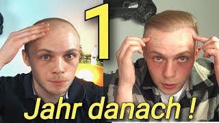 1 Jahr nach Haartransplantation Ergebnis [upl. by Buttaro975]