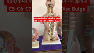 Cervical Problem amp Lower Back Pain Treatment shorts sciatica neckpain [upl. by Ylrebmic]