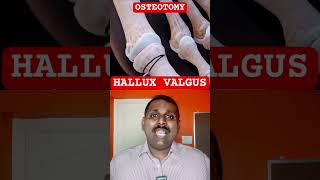 HALLUX VALGUS procedure [upl. by Walburga562]