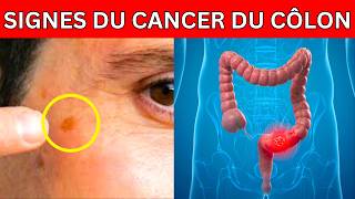 ALERTE  Ce symptôme étrange pourrait indiquer un cancer du côlon [upl. by Salakcin297]