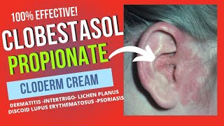 CLOBESTASOL PROPIONATE CREAM REVIEW [upl. by Nayrbo467]