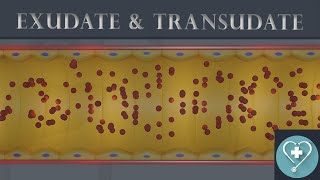 Exudate and Transudate  Introduction  Pathology [upl. by Ahsai233]