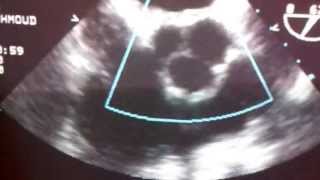 Aortic incompetence and prosthetic mitral valve [upl. by Declan160]