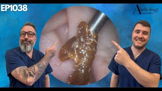 Satisfying Ear Wax amp Skin Removals  EP1038 [upl. by Crin]