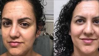 Meladerm Before and After Pictures Amazing Results [upl. by Banna219]