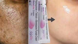 SkinLite Cream Review 2023  Uses Benifits and SideEffects of SkinLite Cream Skin Whitening Cream [upl. by Airoled]