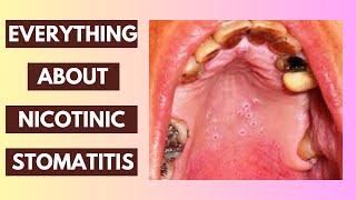 Nicotinic Stomatitis Explained Causes Symptoms and Treatment Options  InDepth Lecture [upl. by Deloria]