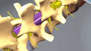 What to expect during an Epidural Steroid Injection at RAYUS [upl. by Eleonora]