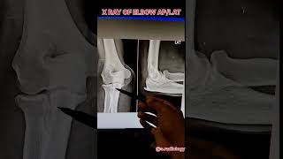 X Ray of Elbow joint osteophytes [upl. by Nawak847]