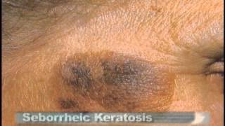 Common Skin Lesions [upl. by Ecnarwal509]