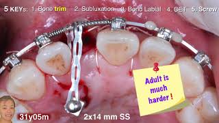 Innovative Impaction Treatment in AAO 2018 Part 4｜【Chris Chang Ortho】CC465 [upl. by Locin]